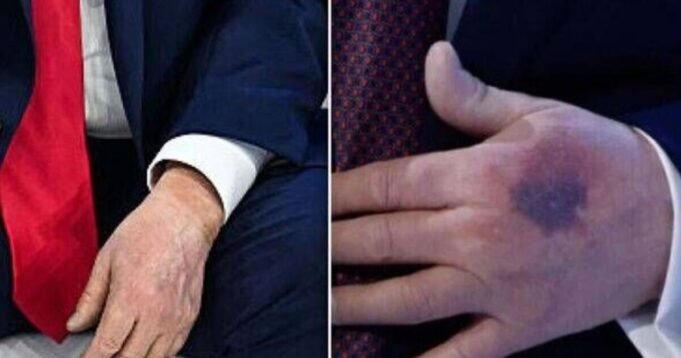 La Casa Bianca spiega la causa della mano nera di